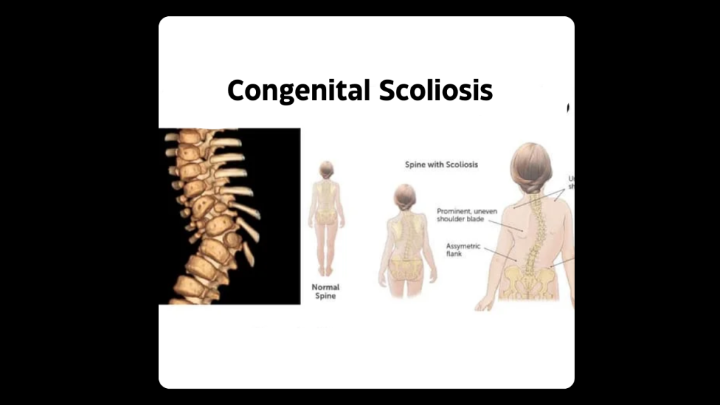 Congenital Scoliosis